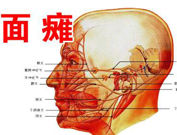 如何估计面瘫的预后情况